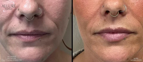 Before and after comparison of a lip filler procedure featuring close-up views of a person's lower face. The left side shows the lips prior to treatment, and the right side shows the results post-procedure.