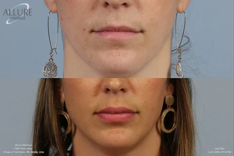 Side-by-side comparison of lips before (top) and after (bottom) lip filler treatment. The bottom image shows fuller lips. Both images feature a woman wearing earrings. Clinic details are visible.