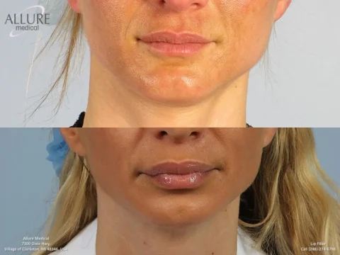 Side-by-side images showing a woman's face before (top) and after (bottom) a lip filler treatment, highlighting changes in lip volume and skin texture.