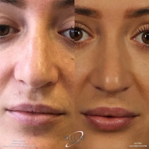 Before and after images of a woman's face highlighting the results of lip filler treatment. The left side shows the face before the procedure; the right side shows smoother, fuller lips post-treatment.