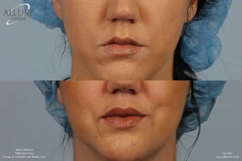 Close-up of a woman's lips and lower face before and after a lip filler procedure. The top image shows her lips before the treatment, and the bottom image shows them fuller and more defined after the procedure.