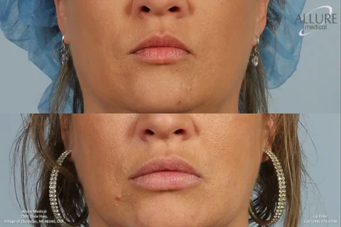 A before-and-after image showing the lower face of a woman with lip fillers. The top image shows her lips before the procedure, while the bottom image displays her fuller lips after the procedure.