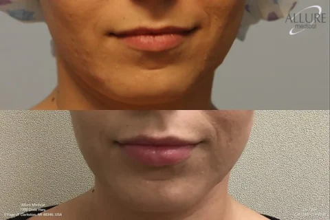 Before and after images of a person's lower face showing improved skin texture and tone.