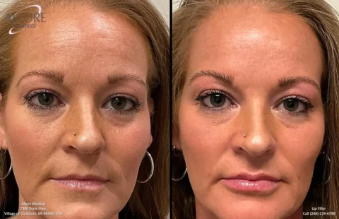 A side-by-side comparison of a woman's face before and after lip filler treatment, with visible enhancements in the lip area. The left image is labeled "before" and the right image is labeled "after.