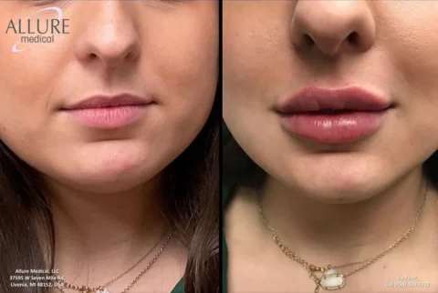 Side-by-side comparison of a woman's face before and after lip filler treatment. The "before" image shows thinner lips, while the "after" image reveals noticeably fuller lips.