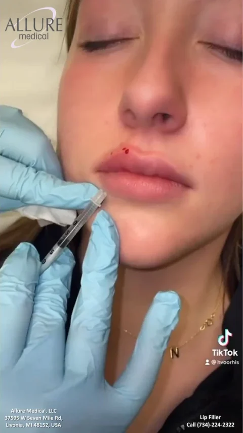 A person with eyes closed is undergoing a lip filler injection by a gloved individual. The lower lip has a small amount of blood. Clinic details and contact number are visible at the bottom of the image.