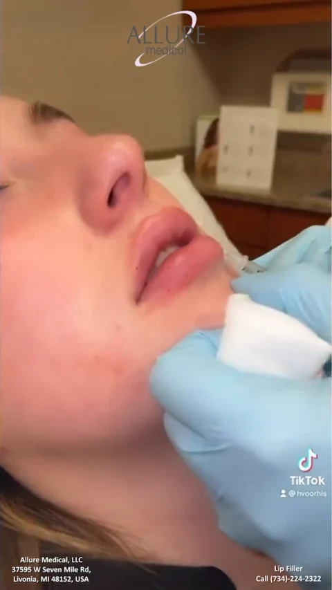 A person receives a lip filler injection at Allure Medical. The injector wears blue gloves and uses a white pad during the procedure. Clinic contact information is visible at the bottom.