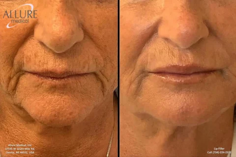 Before and after images of a person's lower face showing the effects of lip filler treatment. The left side shows the face before the treatment, and the right side shows the face after the treatment.