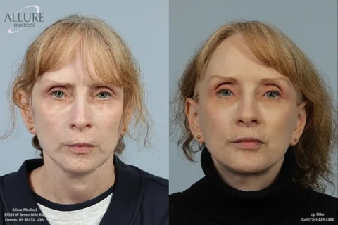 Side-by-side comparison of a woman before (left) and after (right) a cosmetic procedure. The right image shows noticeable changes in her facial appearance, particularly around the lips and cheeks.