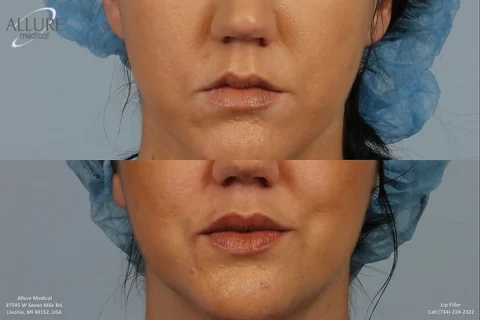 Before and after images of a woman's lips showing the results of a lip filler treatment. The "before" image is at the top, and the "after" image is at the bottom, featuring fuller lips.