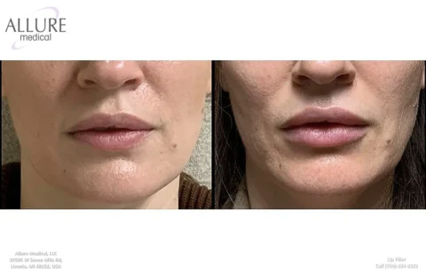 Side-by-side comparison of lips before (left) and after (right) lip filler treatment, showing increased fullness and volume.