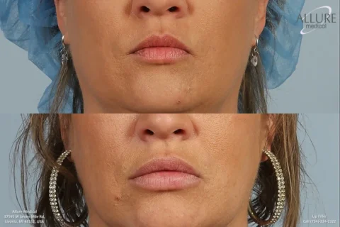 Before and after close-up photos of a woman's lips showing results of a cosmetic lip filler procedure. Top image is before, bottom image is after.