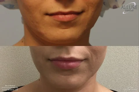 Before and after comparison of a person's lower face showing improvements in skin smoothness and lip fullness. The "before" image is at the top, and the "after" image is at the bottom.