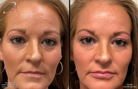 Before and after image of a woman's face illustrating the results of a cosmetic lip filler procedure. The photo on the left shows the face before the procedure, and the photo on the right shows the face afterward.