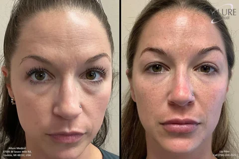 Side-by-side comparison of a woman's face before and after a cosmetic lip filler procedure. The image shows subtle changes in the fullness and shape of the lips.