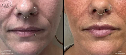 Side-by-side comparison of a person's lower face before and after a skin treatment, showing noticeable improvement in skin texture and reduction of fine lines. Both images feature facial piercings.