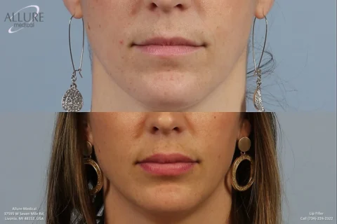 Before and after comparison of lip fillers. Top shows lips before treatment, bottom shows fuller lips after treatment. Allure Medical logo and contact information visible.