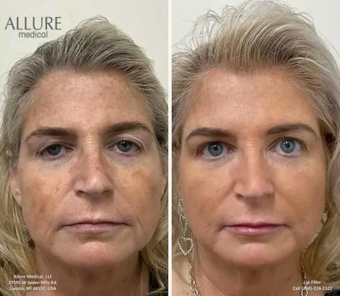 Before and after photos of a person who received lip filler treatment. The left image shows the person's appearance before treatment, and the right image shows the appearance after treatment.