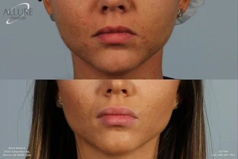 Before and after images showing a woman's chin and lips with acne and smoother complexion post-treatment.