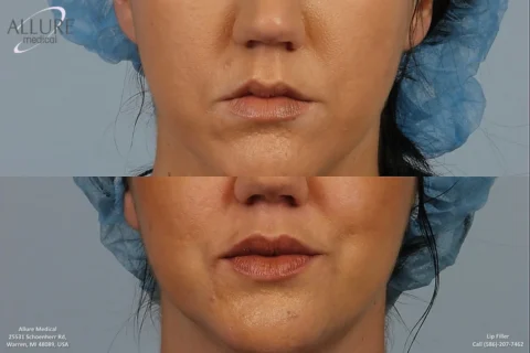 A before-and-after image showing a woman's lips following a lip filler procedure. The top image shows her lips before the treatment, and the bottom image displays the enhanced lips after the procedure.