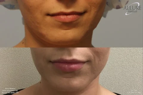 Before and after photos of a person's lower face and neck showing skin condition improvement, with the "before" image on top and the "after" image below.