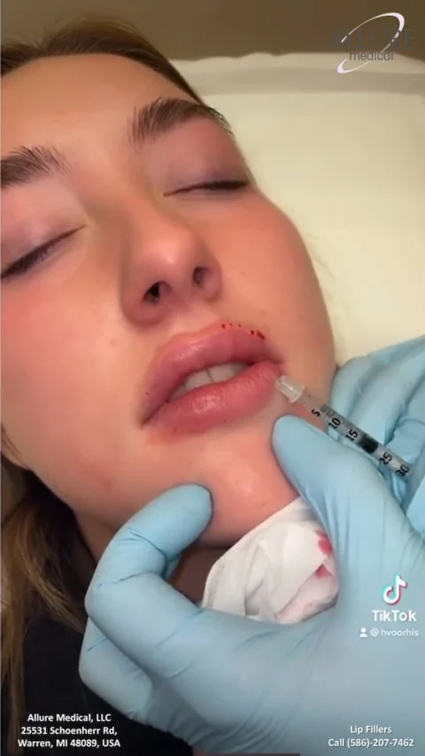 A person is receiving lip fillers via injection by a medical professional wearing blue gloves at Allure Medical, LLC, in Warren, MI.