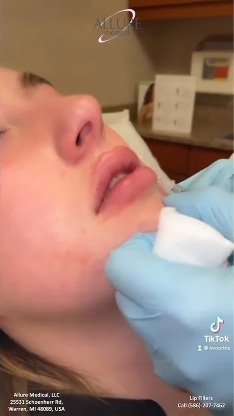 A close-up of a person receiving lip filler injections at Allure Medical. The provider's gloved hands hold cotton near the person's lips. The clinic's contact info is visible at the bottom.