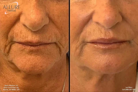 Two side-by-side images compare the lower faces of an older woman before and after a cosmetic lip filler procedure. Wrinkles and lip volume improvements are noticeable in the after photo on the right.