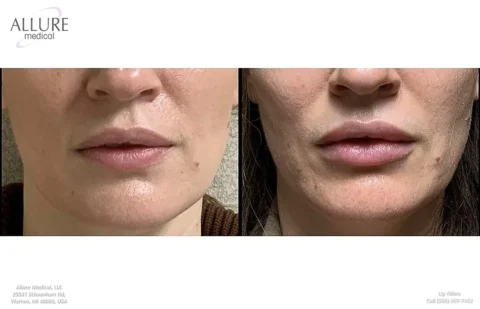 Before and after images comparing lips treated with fillers, showing enhanced volume and definition in the after image.