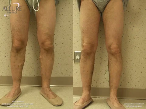 Comparison of legs showing before (left) and after (right) varicose vein treatment. The image is provided by Allure Medical, with visible improvements in vein appearance. Contact info is displayed at the bottom.