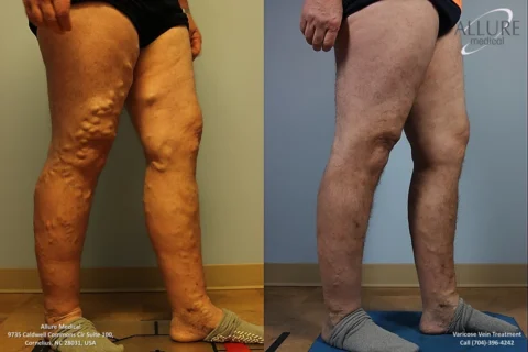 Comparison of legs before and after varicose vein treatment; left leg shows prominent varicose veins, while right leg appears smoother and healthier. Image includes contact info for Allure Medical.