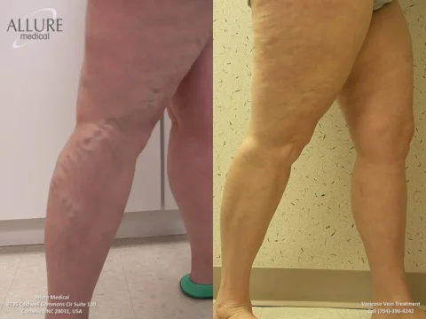 Side-by-side comparison of varicose vein treatment results on legs: left image shows legs with visible varicose veins; right image shows legs after treatment with reduced veins.