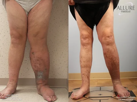 Side-by-side before (left) and after (right) images of a person's legs showing treatment for varicose veins; visible improvements in skin condition and swelling are evident.