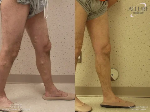 Side-by-side before and after images showing varicose vein treatment on a person's leg. The left image shows prominent veins, while the right image shows diminished veins.