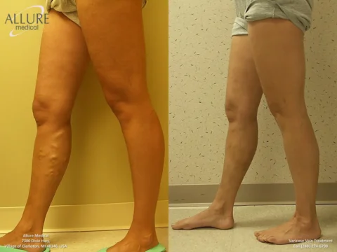 Comparison of legs showing a before and after effect of a varicose vein treatment; the left side depicts the untreated leg and the right side shows the leg post-treatment.