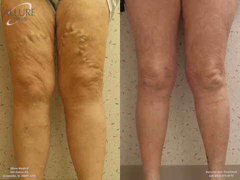 A comparison of legs before and after varicose vein treatment. The left image shows pronounced varicose veins, while the right image shows improved leg appearance post-treatment.