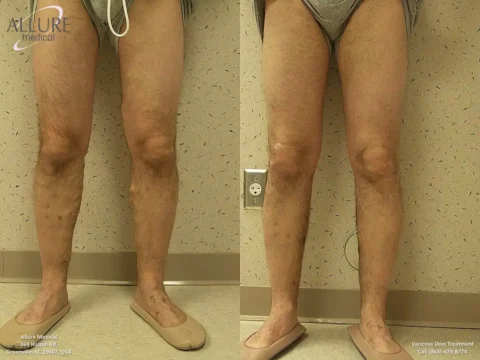 A before and after comparison of a patient's legs treated for varicose veins. The left image shows legs with varicose veins; the right image shows legs with significantly reduced varicose veins.