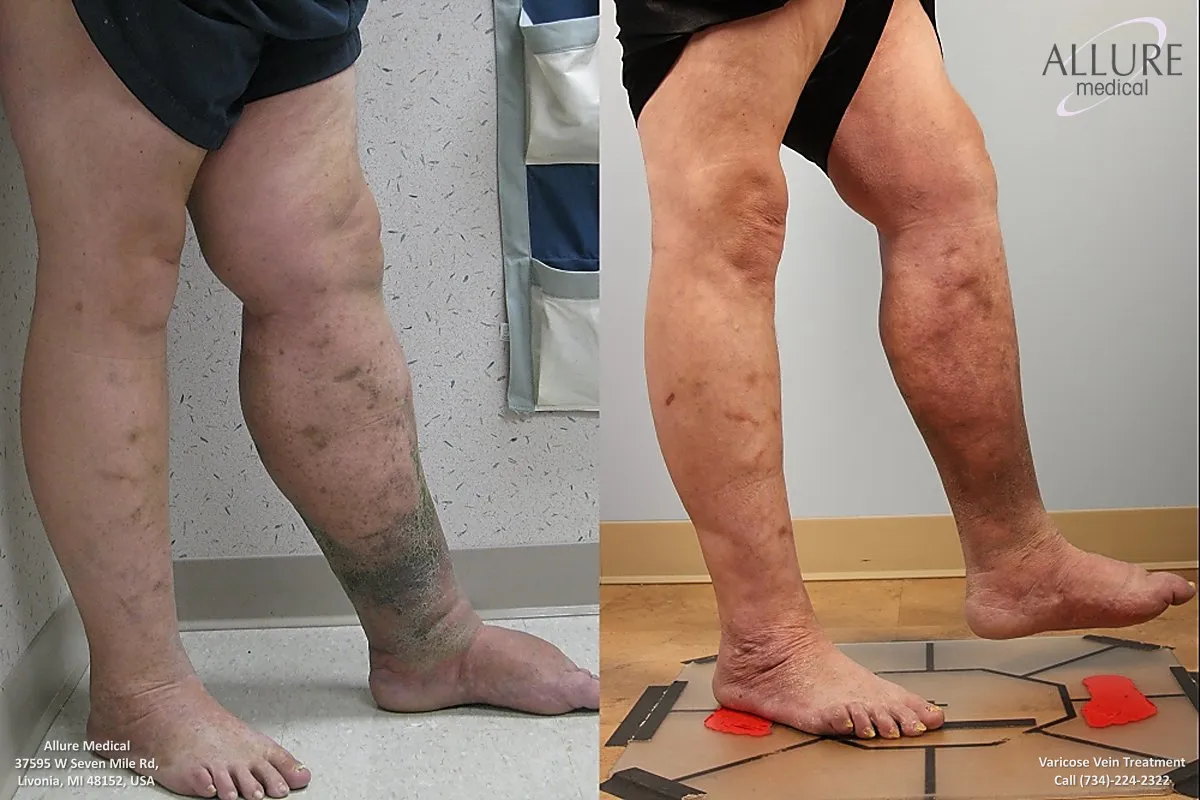 Comparison of a person's leg before and after varicose vein treatment. The left image shows a leg with pronounced varicose veins and discoloration, while the right image shows significant improvement.