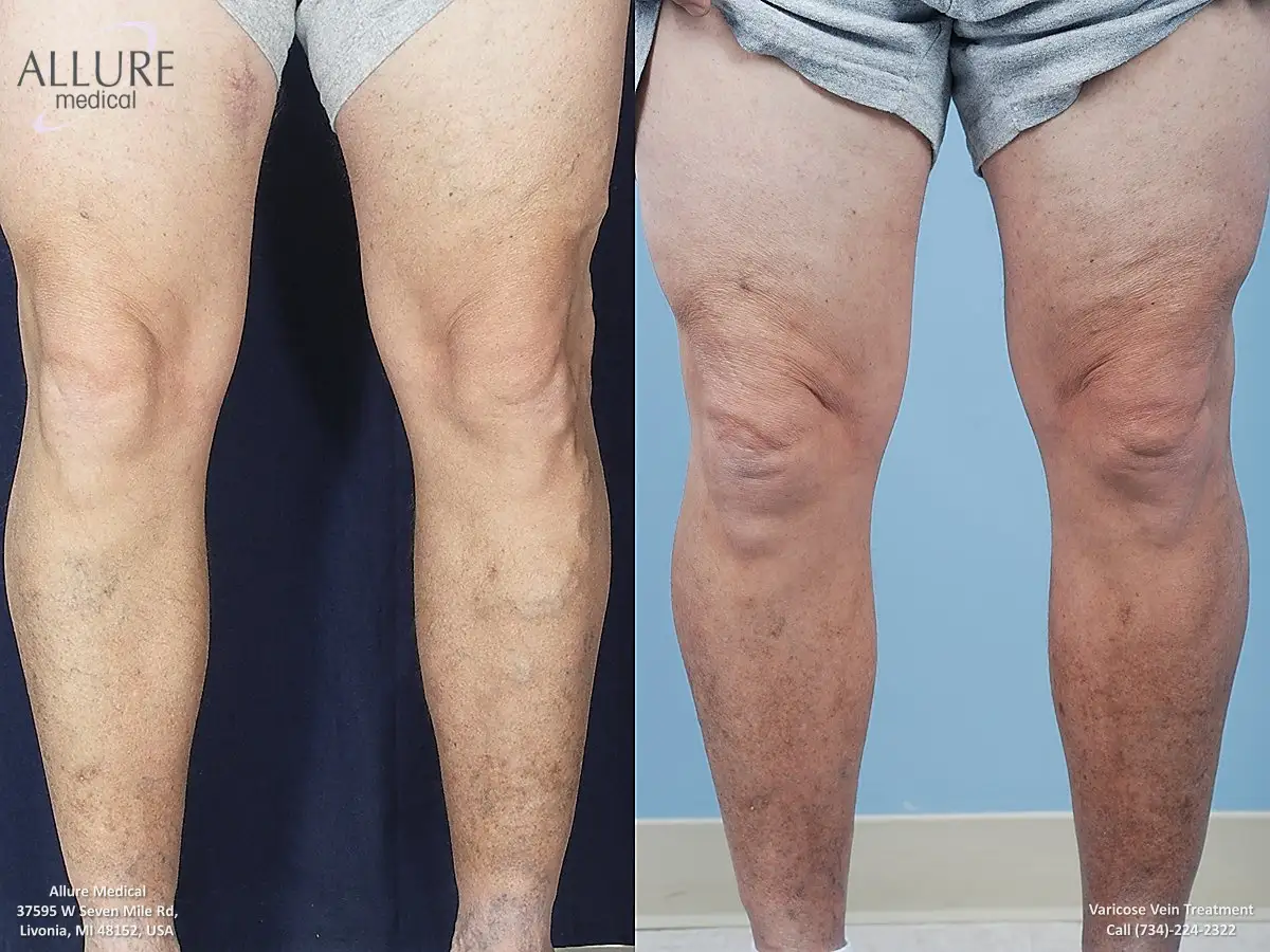 Before and after photo of legs showing the results of varicose vein treatment, with the left image depicting veins and discoloration, and the right image showing significant improvement.