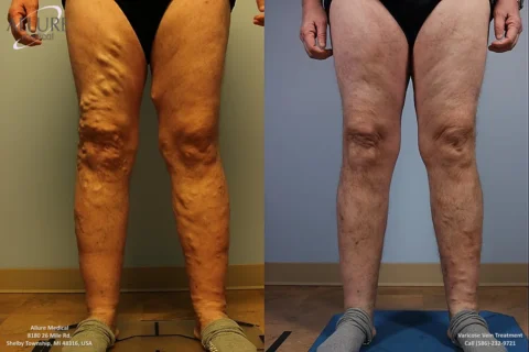 Before and after image showing the front view of legs treated for varicose veins. The left side displays prominent veins, while the right side shows reduced vein visibility.