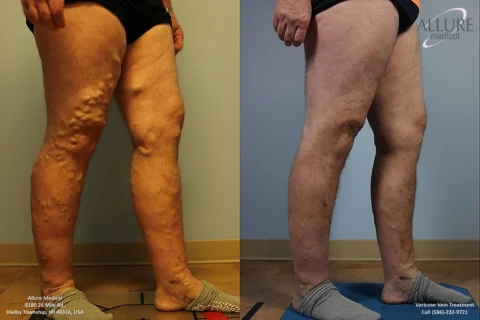 Before and after images showing varicose vein treatment on a right leg. The left image shows the leg with bulging veins, and the right image shows the leg post-treatment with smoother skin.