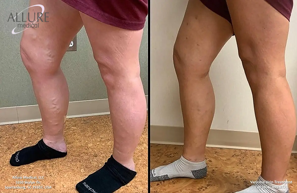 Side-by-side image comparison showing a person's lower legs before (left) and after (right) varicose vein treatment, highlighting noticeable reduction in visible veins.