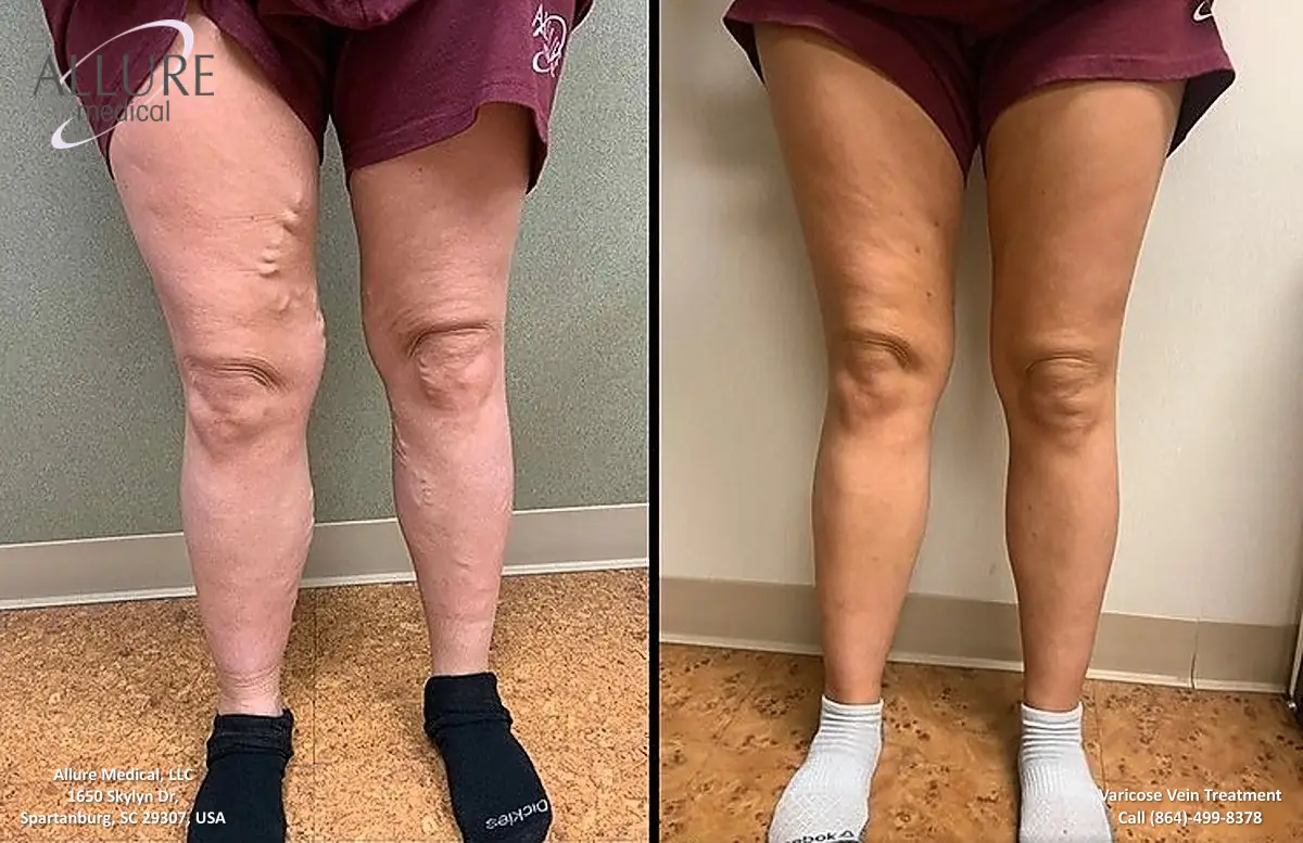 Before and after image showing a person's legs with visible varicose veins on the left and smoother skin without visible varicose veins on the right.