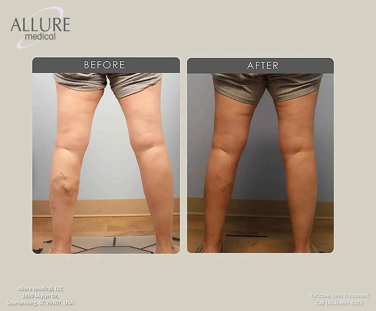 Before and after images of a person's legs showing the results of varicose vein treatment. The "before" image displays visible varicose veins, whereas the "after" image shows smoother legs.