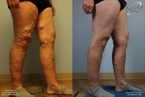 Before and after treatment for varicose veins, showing significant improvement in appearance of the legs. Left leg displays pronounced varicose veins, while right leg appears smoother.