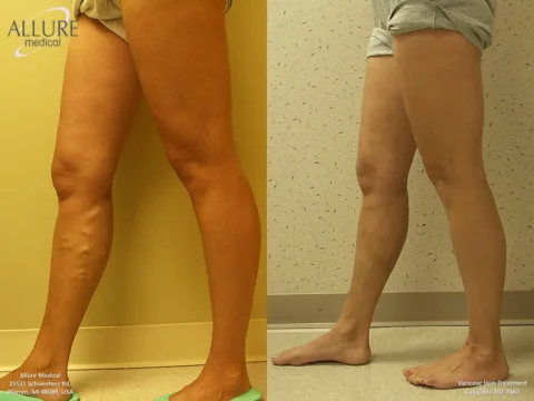 Side-by-side comparison of a person's legs showing the effects of varicose vein treatment. The left image shows veins before treatment, and the right image shows the same legs with reduced vein visibility.