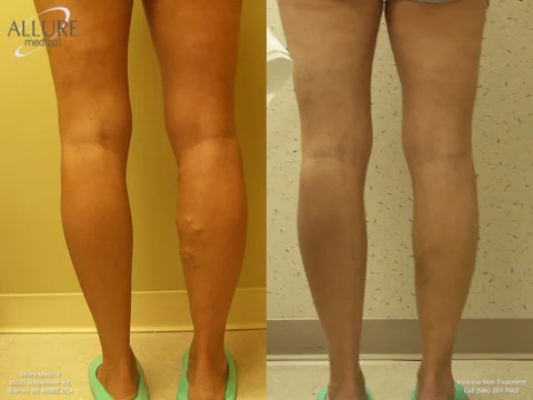 Comparison showing the back of a person's legs before (left) and after (right) varicose vein treatment. The "before" side shows prominent veins, while the "after" side shows smooth skin.