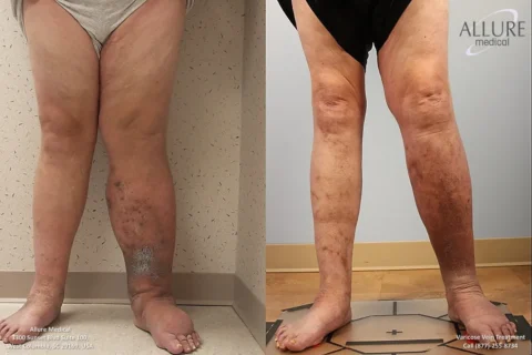 Side-by-side images showing a person's legs before and after varicose vein treatment. The left image shows numerous varicose veins, while the right image shows significantly clearer skin.