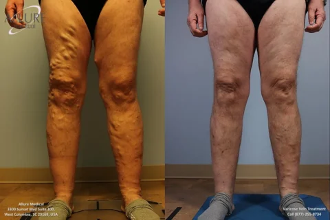 Before-and-after images of legs showing improvement in varicose veins after treatment. Left image shows pronounced veins, right image shows smoother skin and less visible veins.