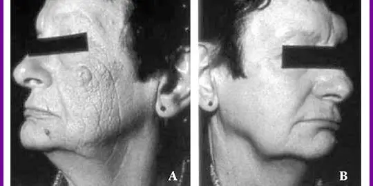 Two side-by-side black-and-white photos showing the left profile of a person's face before (A) and after (B) treatment, with improved skin texture and reduced wrinkles in the after image.